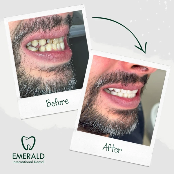 Il percorso di Impianto dentali con foto prima–dopo – caso 425
