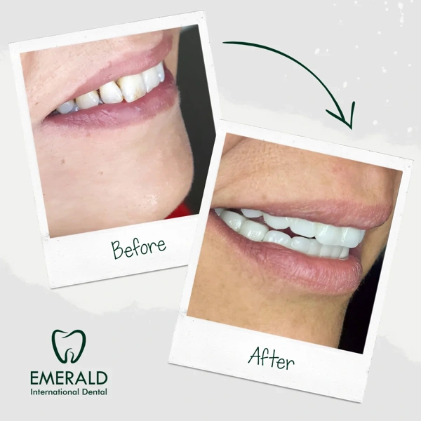 Sami Guvenc Faccette dentali results in Turkey – case 437