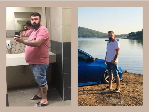Ibrahim Karatas Gastrectomia a manica results in Turkey – case 300