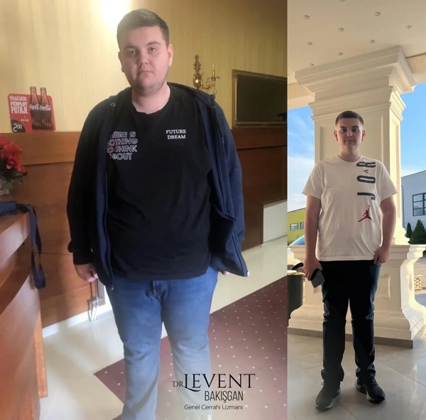 Levent Bakısgan Gastrectomia a manica results in Turkey – case 500
