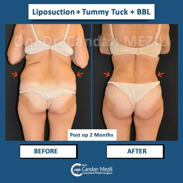 Galleria prima e dopo BBL (Lifting dei glutei brasiliano) – Femmina caso 444