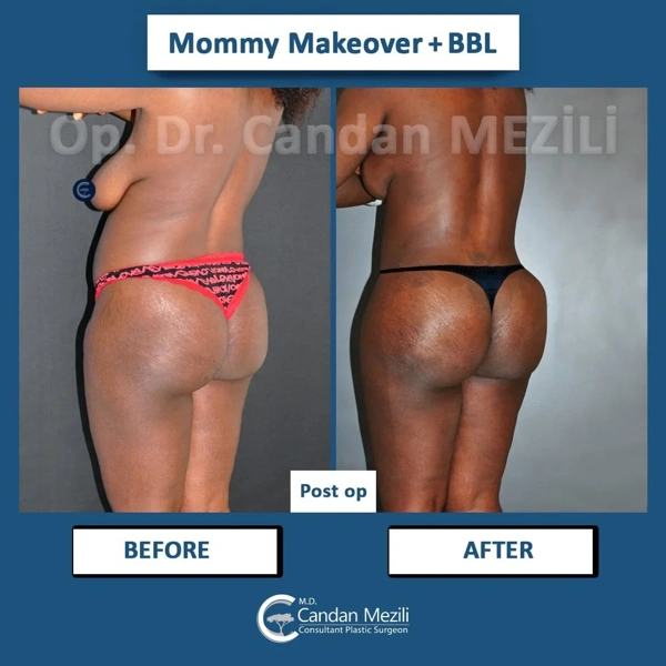 Galleria prima e dopo BBL (Lifting dei glutei brasiliano) – Femmina caso 445