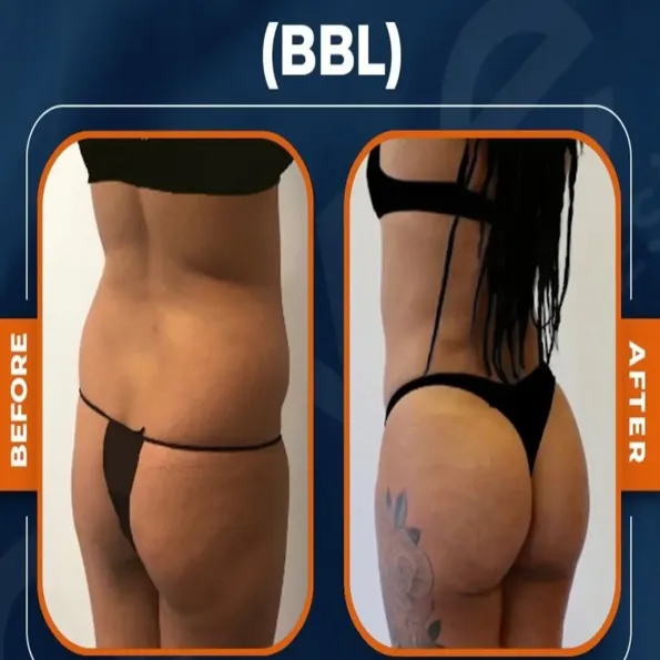 Risultati prima e dopo di BBL (Lifting dei glutei brasiliano) a Turchia – caso 620