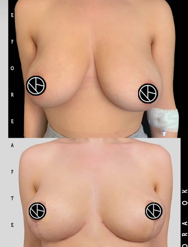 Bora  Ok Lifting del seno (Mastopessi) results in Turkey – case 149