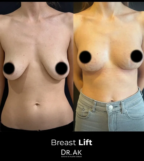 Erman Ak Lifting del seno (Mastopessi) results in Turkey – case 602