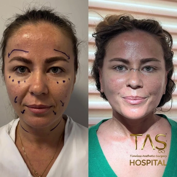 Suleyman  Tas Lifting viso results in Turkey – case 273