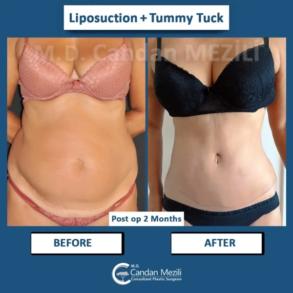 Candan Mezili Liposuzione results in Turkey – case 592