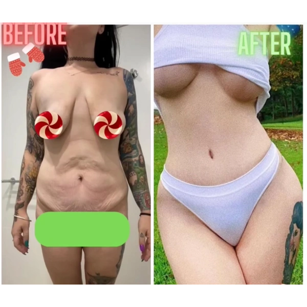 Cagdas Orman Mommy Makeover results in Turkey – case 691
