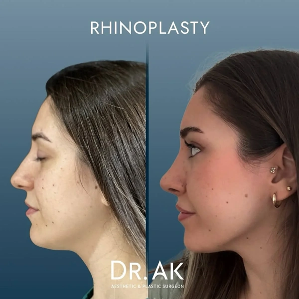 Erman Ak Rinoplastica (Operazione al naso) results in Turkey – case 8