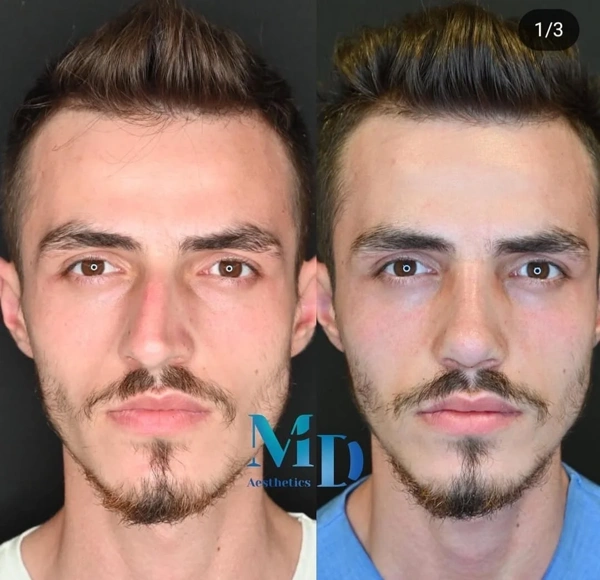 Murat  Diyarbakırlıoglu Rinoplastica (Operazione al naso) results in Turkey – case 220