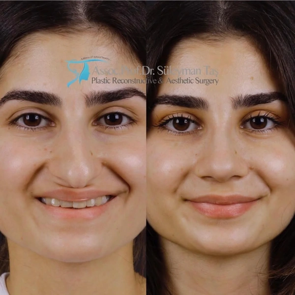 Suleyman  Tas Rinoplastica (Operazione al naso) results in Turkey – case 278