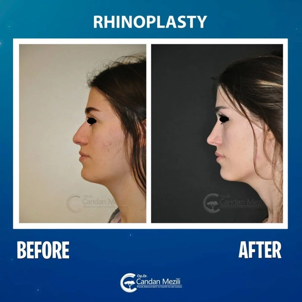 Candan Mezili Rinoplastica (Operazione al naso) results in Turkey – case 440