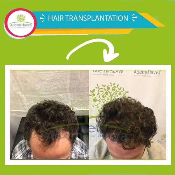 Ilayda  Yuceturk Trapianto capelli results in Turkey – case 107