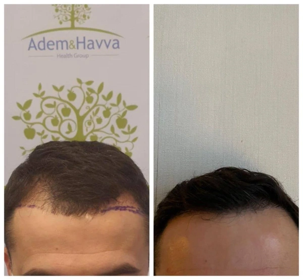 Ilayda  Yuceturk Trapianto capelli results in Turkey – case 118