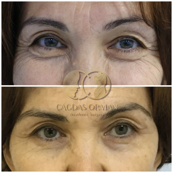Cagdas Orman Blefaroplastiek (Ooglidcorrectie)  results in Turkey – case 171