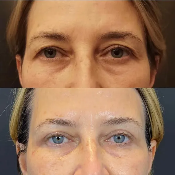 Blefaroplastiek (Ooglidcorrectie)  voor- en naresultaten in Turkije – casus 321