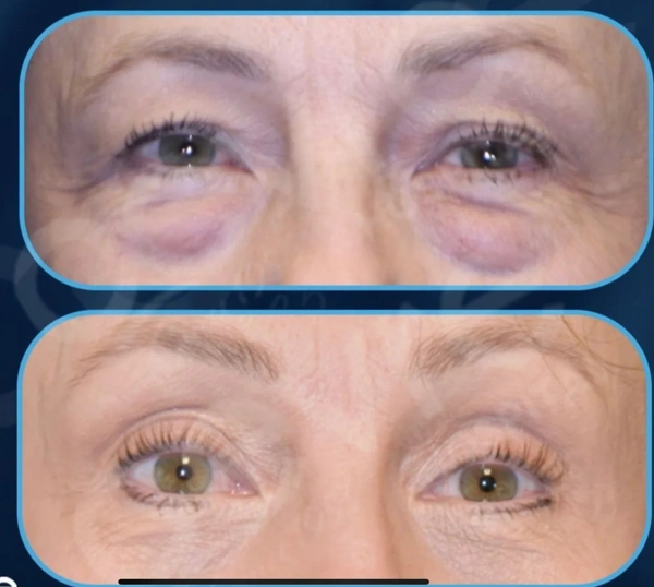 Ali Cem Oktay Blefaroplastiek (Ooglidcorrectie)  results in Turkey – case 624