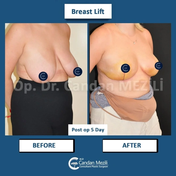 Candan Mezili Borstlifting results in Turkey – case 476