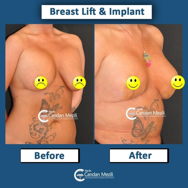 Candan Mezili Borstlifting results in Turkey – case 479