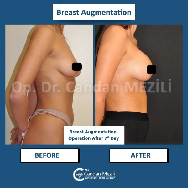 Candan Mezili Borstvergroting results in Turkey – case 481