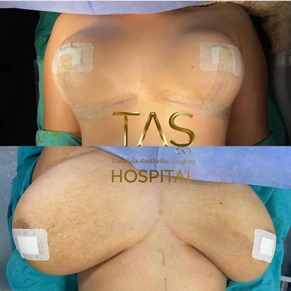 Suleyman  Tas Borstverkleining results in Turkey – case 267