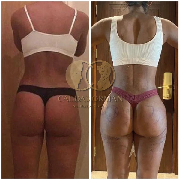 Cagdas Orman BBL (Brazilian Butt Lift) results in Turkey – case 163