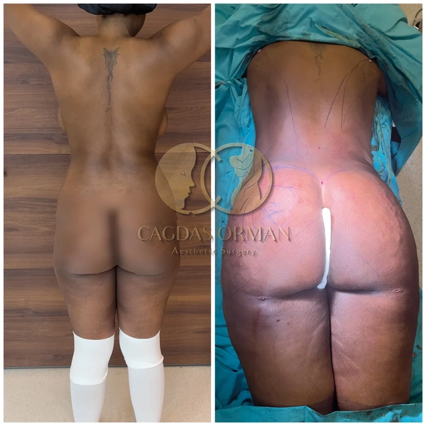 Cagdas Orman BBL (Brazilian Butt Lift) results in Turkey – case 164