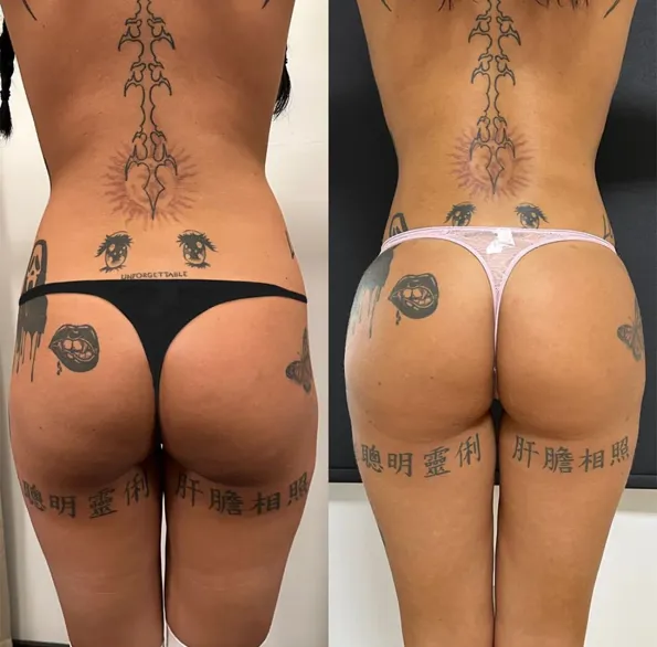 BBL (Brazilian Butt Lift) voor- en naresultaten in Turkije – casus 186