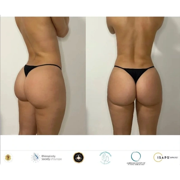 Cagdas Orman BBL (Brazilian Butt Lift) results in Turkey – case 672