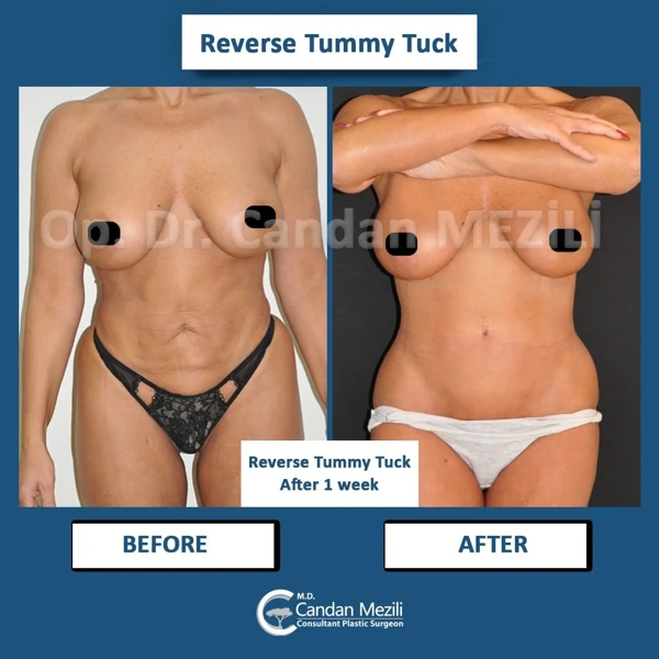 Buikwandcorrectie (Abdominoplastiek) voor–na galerij – Vrouwelijk geval 452