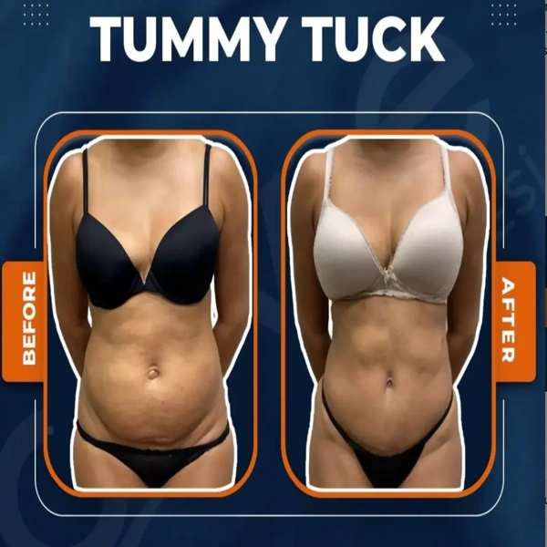 Ali Cem Oktay Buikwandcorrectie (Abdominoplastiek) results in Turkey – case 630