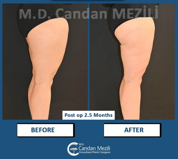 Candan Mezili Volledig lichaamslifting results in Turkey – case 597