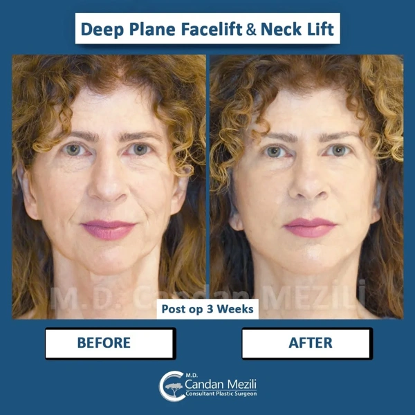 Candan Mezili Facelift results in Turkey – case 9