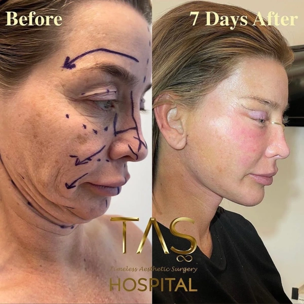 Suleyman  Tas Facelift results in Turkey – case 274