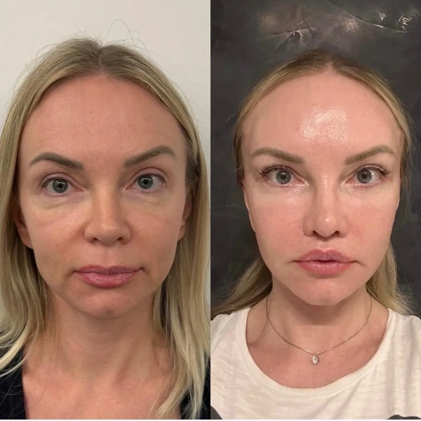Cem Berkay  Sinaci Facelift results in Turkey – case 309