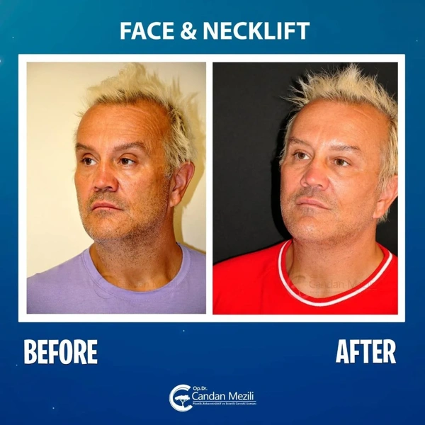 Facelift voor–na galerij – Mannelijk geval 467