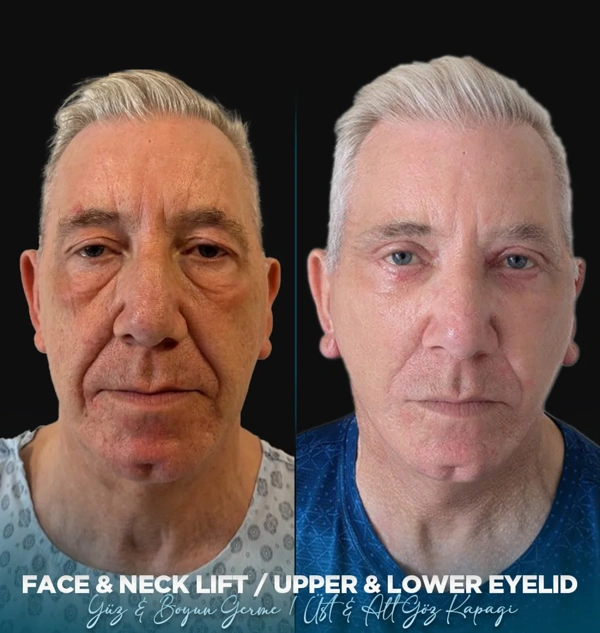 Facelift voor–na galerij – Mannelijk geval 562