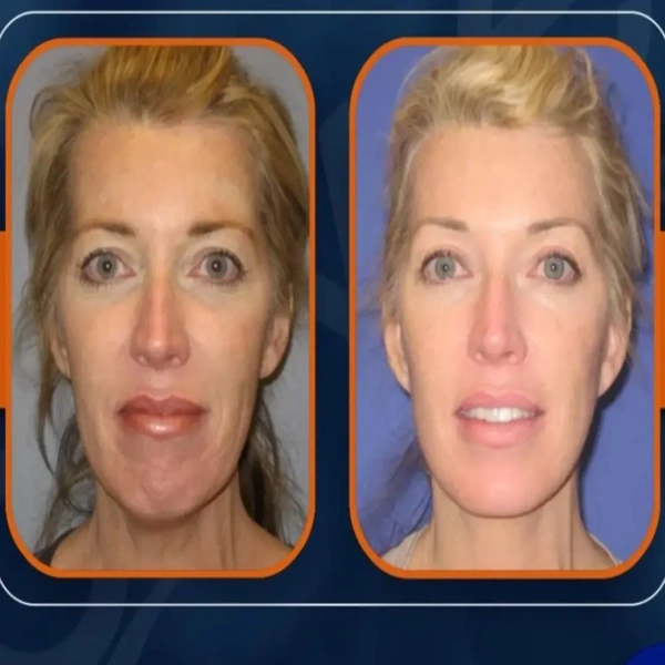 Ali Cem Oktay Facelift results in Turkey – case 625