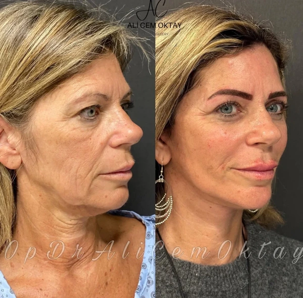 Ali Cem Oktay Facelift results in Turkey – case 63