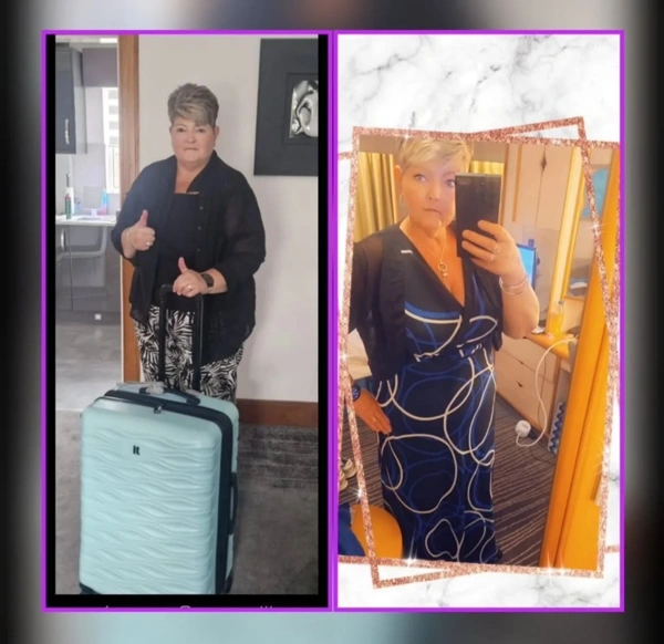 Umut Rıza Gunduz Maagverkleining (Gastric sleeve) results in Turkey – case 506