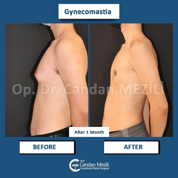 Candan Mezili Gynaecomastie chirurgie results in Turkey – case 447