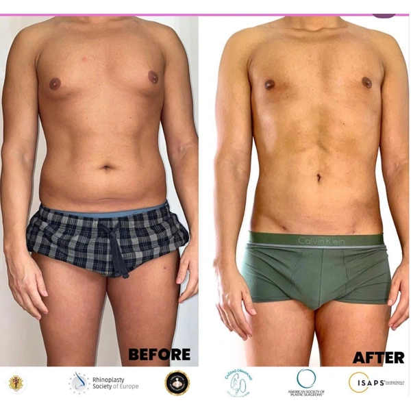 Cagdas Orman Gynaecomastie chirurgie results in Turkey – case 686