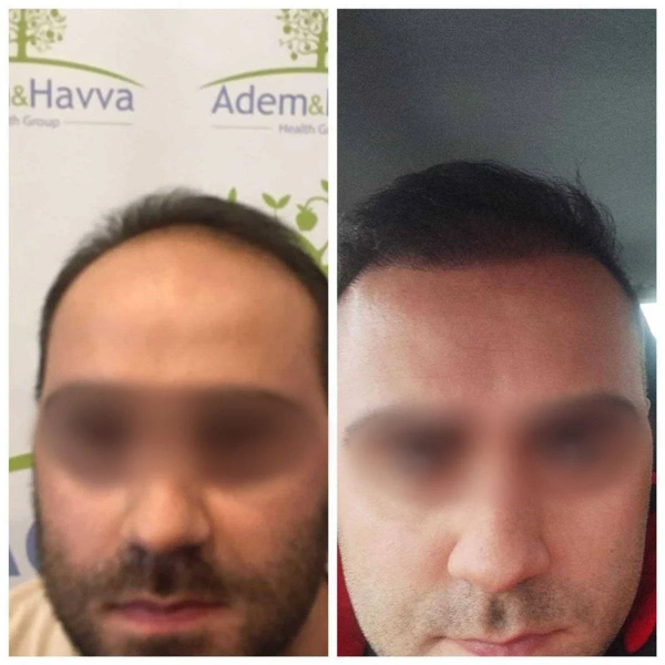 Ilayda  Yuceturk Haartransplantatie results in Turkey – case 100