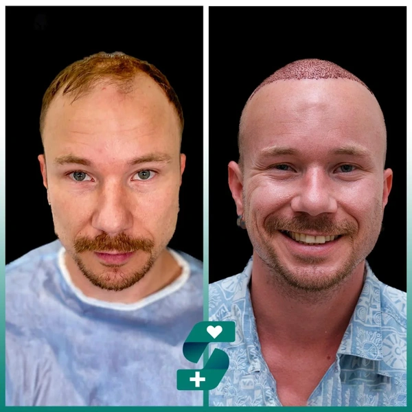 Ilayda  Yuceturk Haartransplantatie results in Turkey – case 514