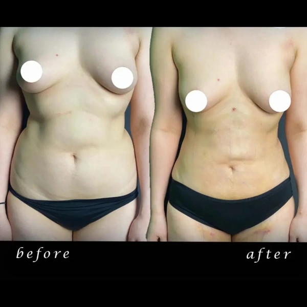 Duran Cekic Liposuctie results in Turkey – case 639