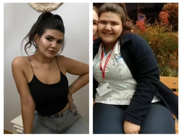 Toygar Toydemir Maagverkleining (Gastric sleeve) results in Turkey – case 243