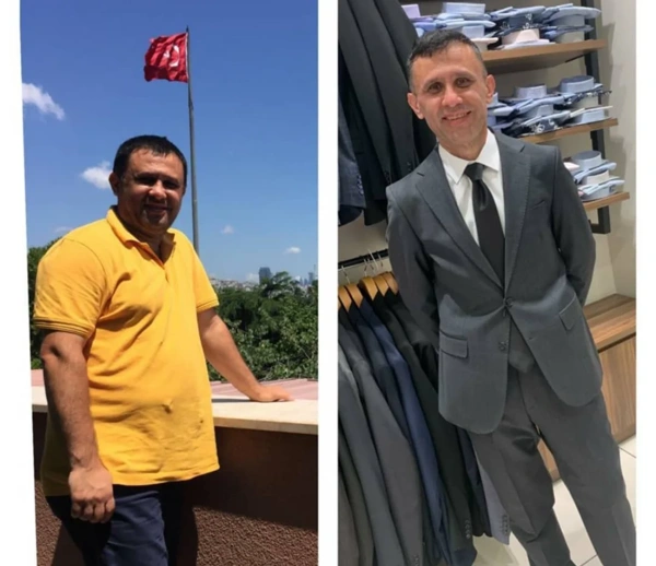 Toygar Toydemir Maagverkleining (Gastric sleeve) results in Turkey – case 251