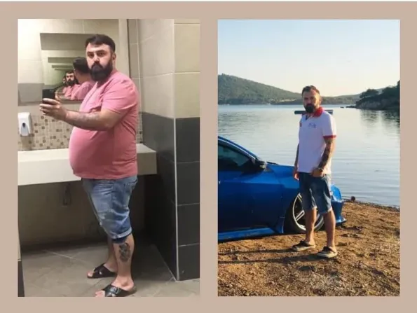 Maagverkleining (Gastric sleeve) voor- en naresultaten in Turkije – casus 300