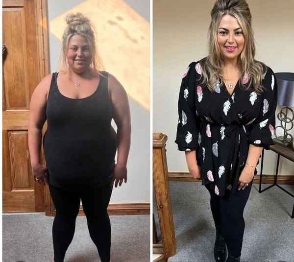 Umut Rıza Gunduz Maagverkleining (Gastric sleeve) results in Turkey – case 508