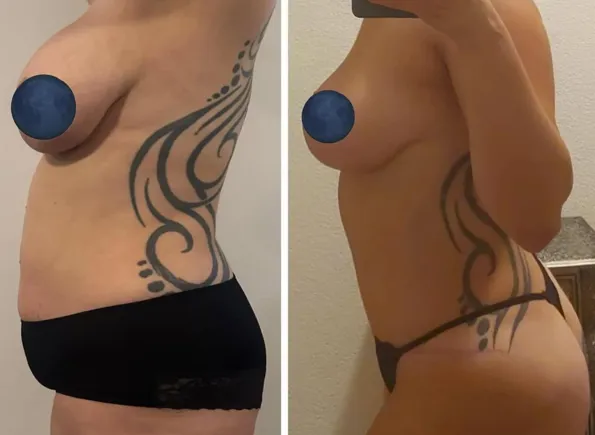 Mommy Makeover voor- en naresultaten in Turkije – casus 191